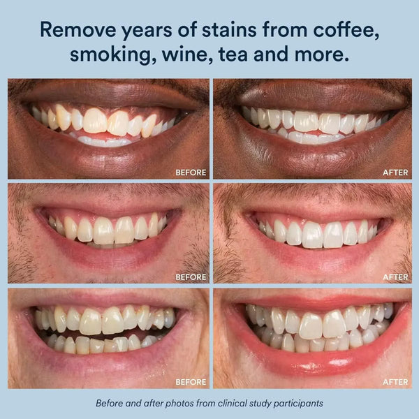22% Teeth Whitening Gel
